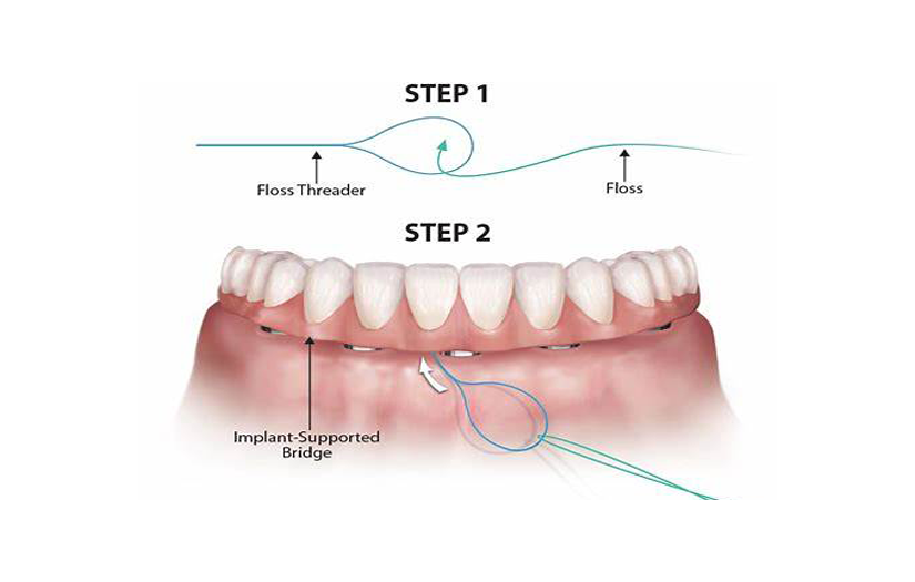 Why Are All-on-X Implant Bridges So Hard to Floss?