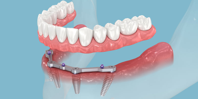 All on X Flossing Guide