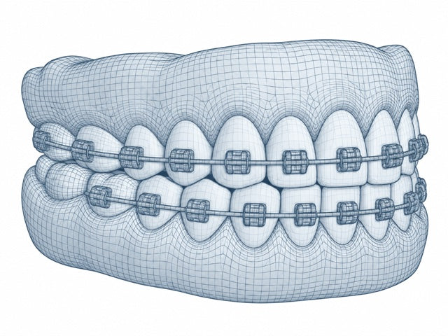Braces