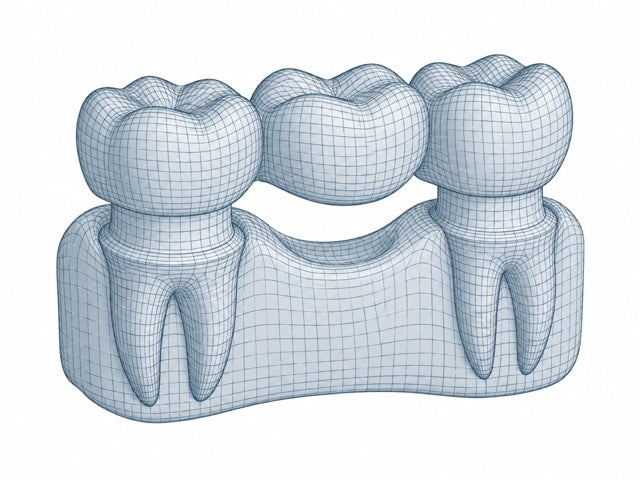 Dental bridges